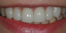 Veneers Dentist Mumbai