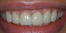 Veneers Dentist Mumbai