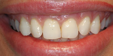 Veneers Dentist Mumbai