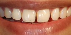 Veneers Dentist Mumbai