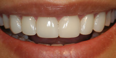 Veneers Dentist Mumbai