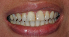best teeth whitening India