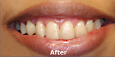 Zoom Whitening teeth Mumbai