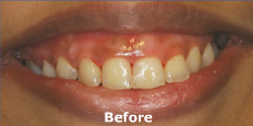 Zoom Whitening teeth Mumbai