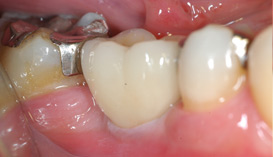 Implant Dentist Mumbai