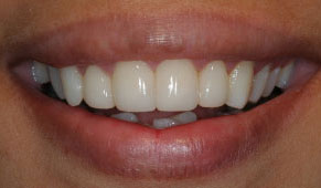 Veneers Dentist Mumbai