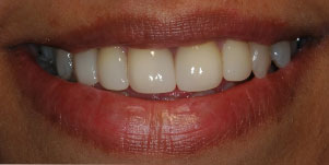 Veneers Dentist Mumbai