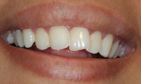 Veneers Dentist Mumbai