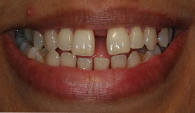 Veneers Dentist Mumbai