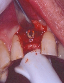 Implant Dentist India