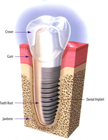Implant Dentist India