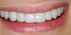 best teeth whitening India