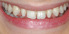 best teeth whitening India