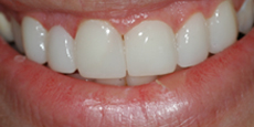 best teeth whitening India