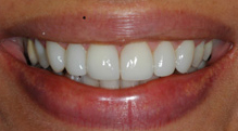 best teeth whitening India