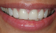 best teeth whitening India