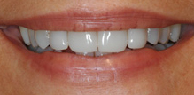 best teeth whitening India