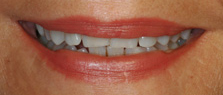 best teeth whitening India