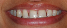 best teeth whitening India