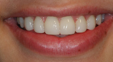 best teeth whitening India