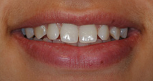 best teeth whitening India