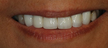 best teeth whitening India