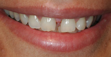 best teeth whitening India