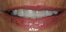 best teeth whitening India