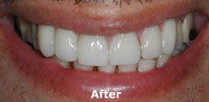 best teeth whitening India